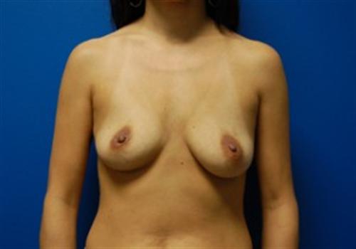 Breast Reconstruction Before and After | SGK Plastic Surgery