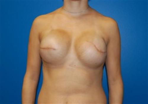 Breast Reconstruction Before and After | SGK Plastic Surgery