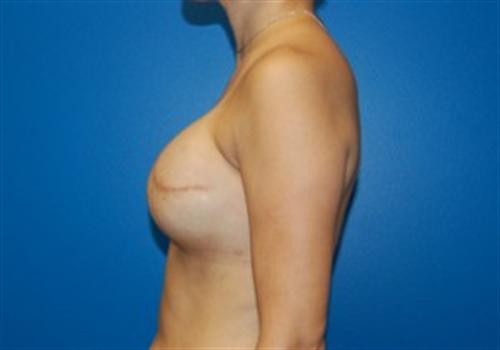 Breast Reconstruction Before and After | SGK Plastic Surgery