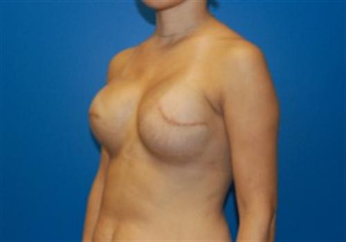 Breast Reconstruction Before and After | SGK Plastic Surgery