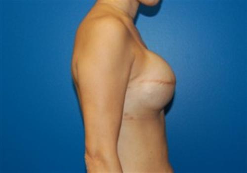 Breast Reconstruction Before and After | SGK Plastic Surgery