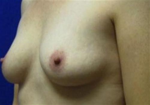 Breast Reconstruction Before and After | SGK Plastic Surgery