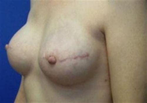 Breast Reconstruction Before and After | SGK Plastic Surgery