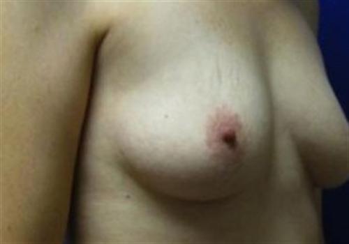 Breast Reconstruction Before and After | SGK Plastic Surgery