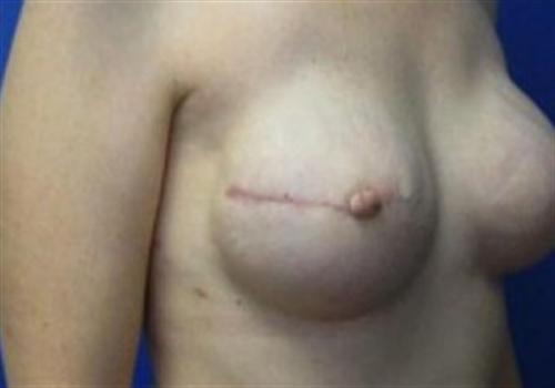 Breast Reconstruction Before and After | SGK Plastic Surgery