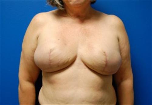 Breast Reconstruction Before and After | SGK Plastic Surgery