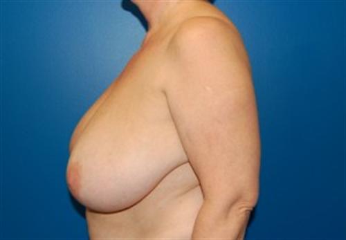 Breast Reconstruction Before and After | SGK Plastic Surgery