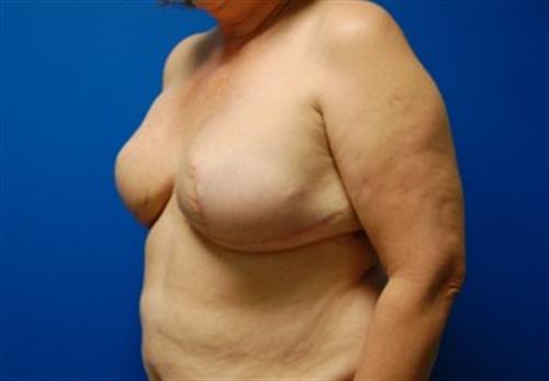 Breast Reconstruction Before and After | SGK Plastic Surgery