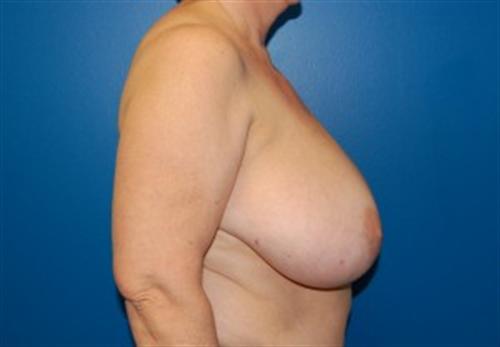 Breast Reconstruction Before and After | SGK Plastic Surgery