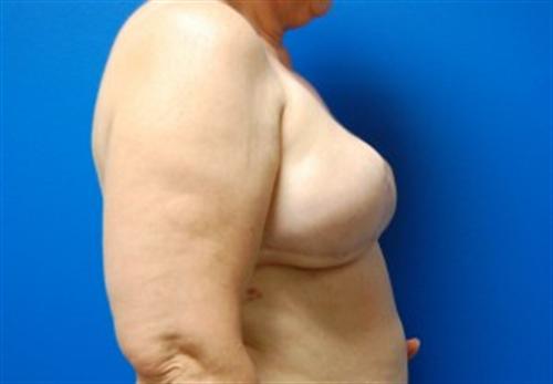 Breast Reconstruction Before and After | SGK Plastic Surgery