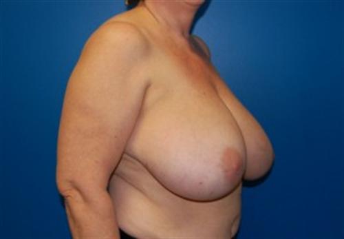 Breast Reconstruction Before and After | SGK Plastic Surgery