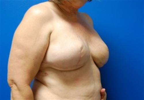 Breast Reconstruction Before and After | SGK Plastic Surgery