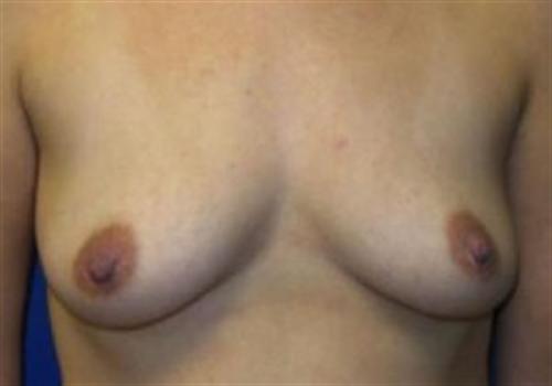 Breast Reconstruction Before and After | SGK Plastic Surgery