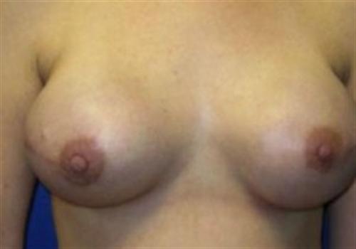 Breast Reconstruction Before and After | SGK Plastic Surgery