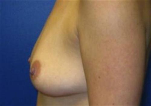 Breast Reconstruction Before and After | SGK Plastic Surgery