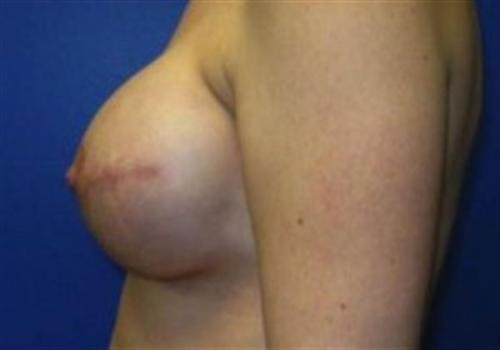 Breast Reconstruction Before and After | SGK Plastic Surgery