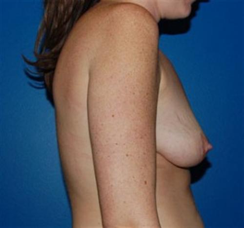 Breast Reconstruction Before and After | SGK Plastic Surgery