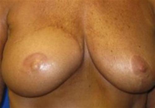 Breast Reconstruction Before and After | SGK Plastic Surgery