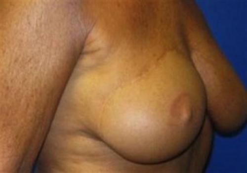 Breast Reconstruction Before and After | SGK Plastic Surgery