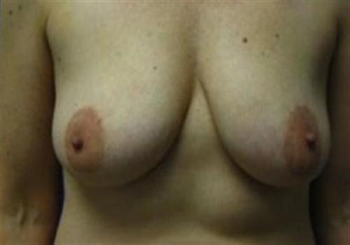 Breast Reconstruction Before and After | SGK Plastic Surgery