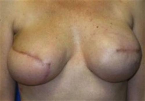 Breast Reconstruction Before and After | SGK Plastic Surgery