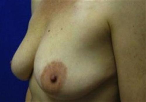 Breast Reconstruction Before and After | SGK Plastic Surgery