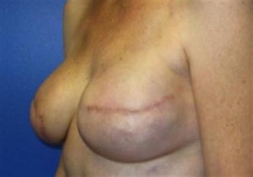 Breast Reconstruction Before and After | SGK Plastic Surgery