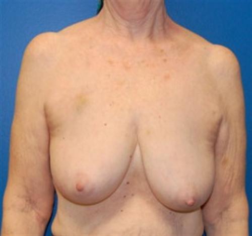 Breast Reconstruction Before and After | SGK Plastic Surgery