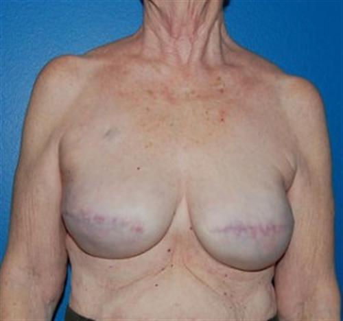 Breast Reconstruction Before and After | SGK Plastic Surgery