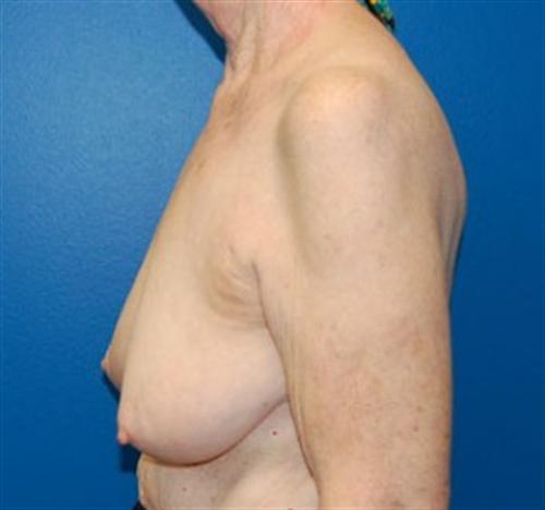 Breast Reconstruction Before and After | SGK Plastic Surgery