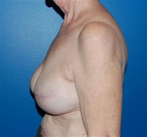 Breast Reconstruction Before and After | SGK Plastic Surgery