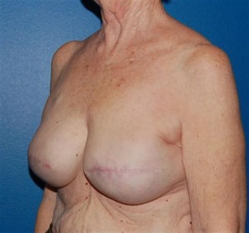 Breast Reconstruction Before and After | SGK Plastic Surgery