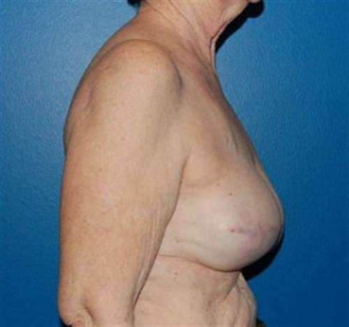 Breast Reconstruction Before and After | SGK Plastic Surgery