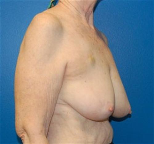 Breast Reconstruction Before and After | SGK Plastic Surgery