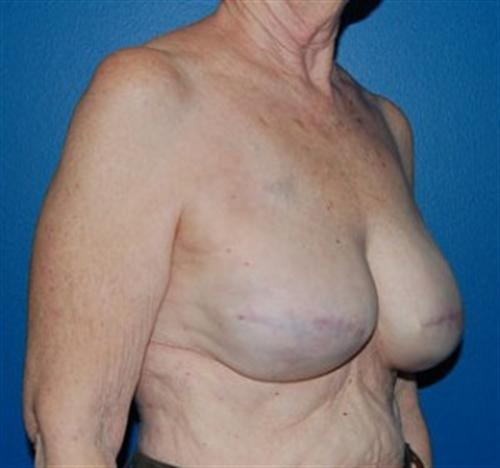 Breast Reconstruction Before and After | SGK Plastic Surgery