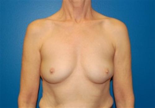 Breast Reconstruction Before and After | SGK Plastic Surgery