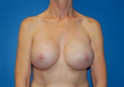 Breast Reconstruction Before and After | SGK Plastic Surgery