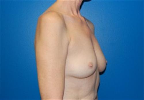 Breast Reconstruction Before and After | SGK Plastic Surgery