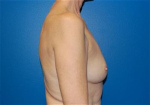 Breast Reconstruction Before and After | SGK Plastic Surgery