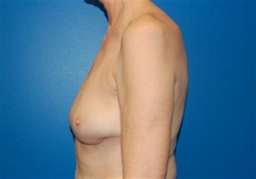 Breast Reconstruction Before and After | SGK Plastic Surgery