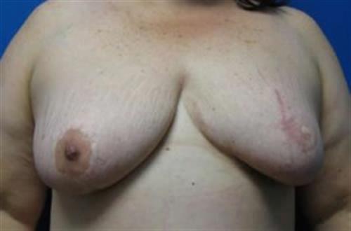 Breast Reconstruction Before and After | SGK Plastic Surgery