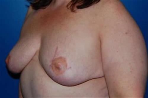 Breast Reconstruction Before and After | SGK Plastic Surgery