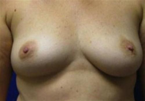 Breast Reconstruction Before and After | SGK Plastic Surgery