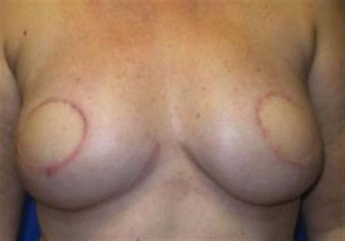 Breast Reconstruction Before and After | SGK Plastic Surgery