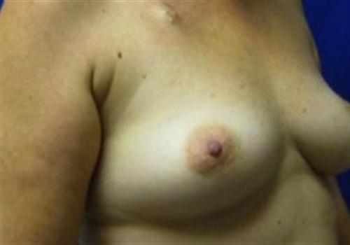 Breast Reconstruction Before and After | SGK Plastic Surgery