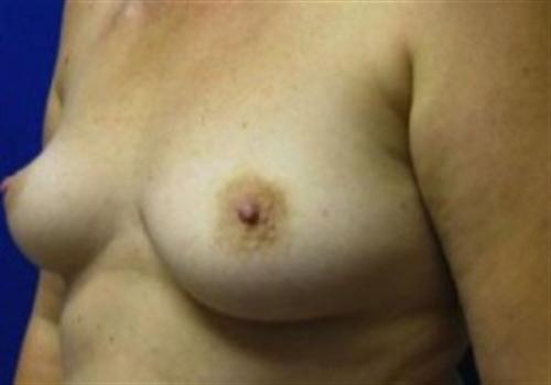 Breast Reconstruction Before and After | SGK Plastic Surgery