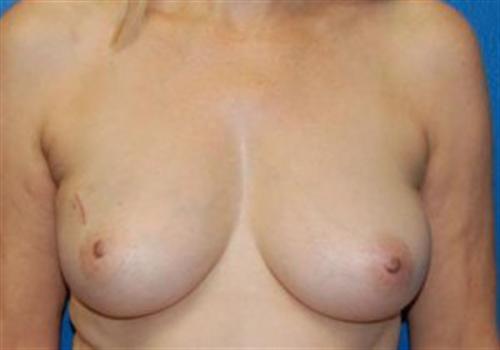 Breast Reconstruction Before and After | SGK Plastic Surgery