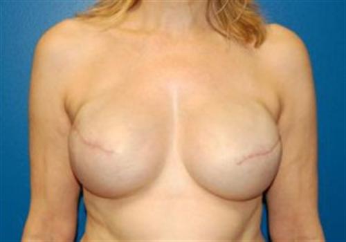 Breast Reconstruction Before and After | SGK Plastic Surgery