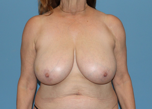 Breast Reduction Before and After | SGK Plastic Surgery