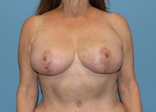 Breast Reduction Before and After | SGK Plastic Surgery